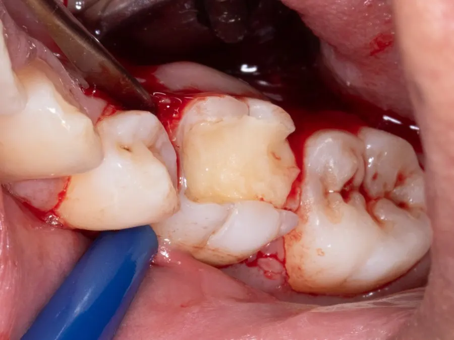 Dente condenado à extração
